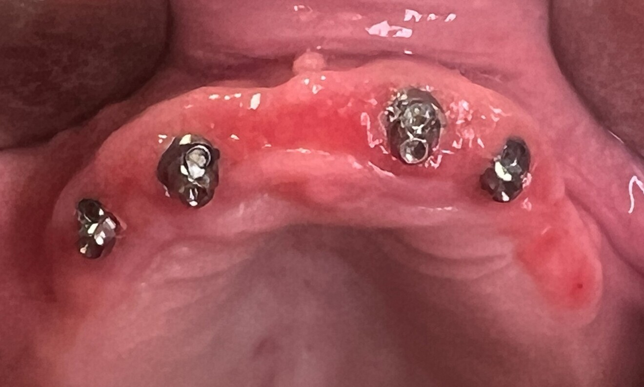 Fig. 3: Areas of chronic inflammation of transmucosal tissue evident after removal of the maxillary prosthesis.