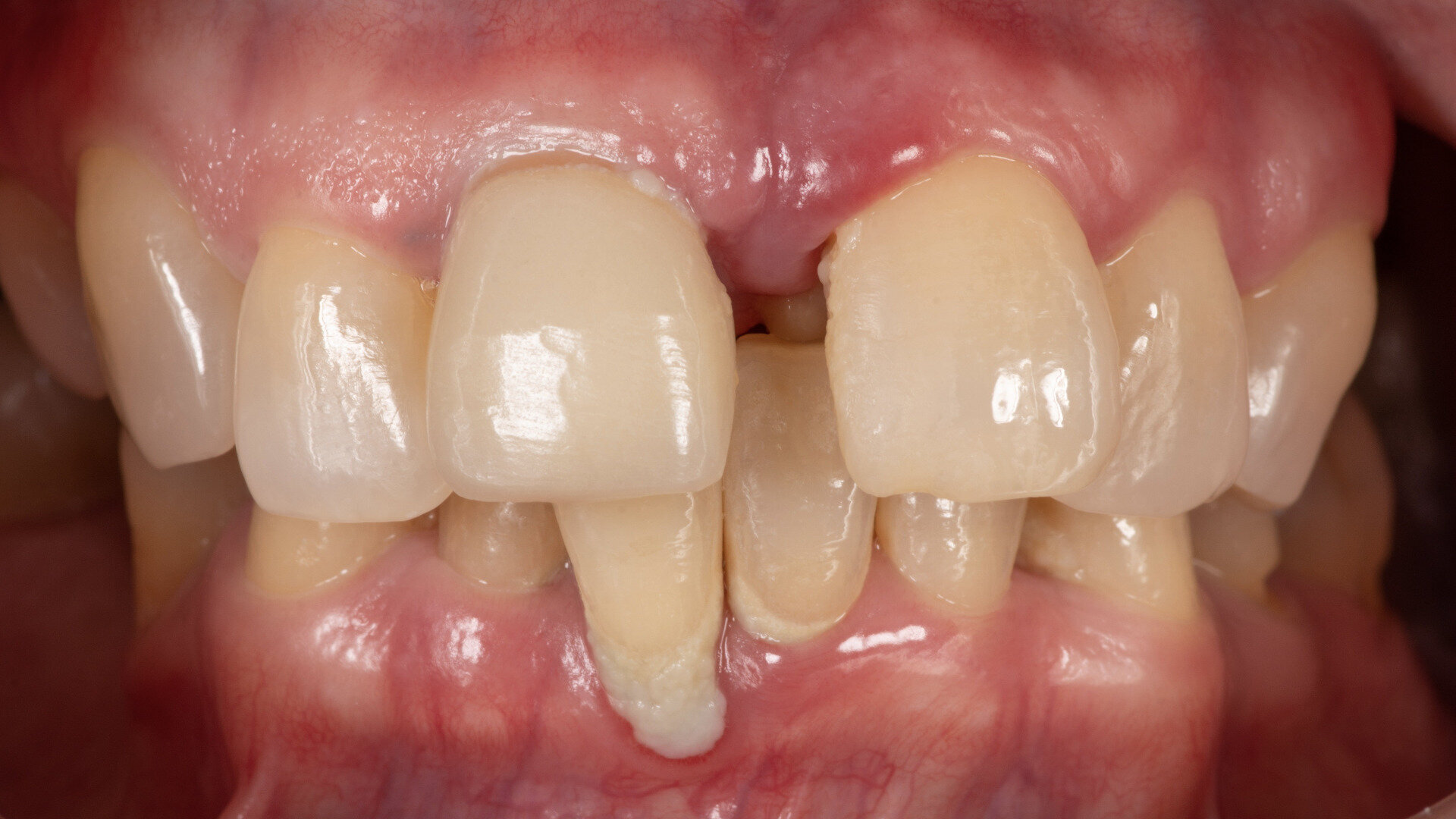 Digital technology for full-arch implant prostheses