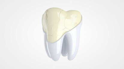Researchers detect mechanism behind tooth enamel disorder in patients with coeliac disease
