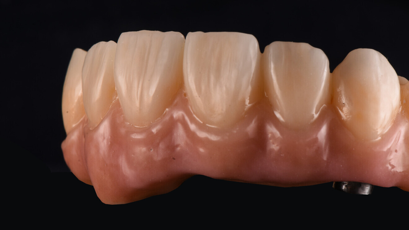 Figs. 6a & b: Lifelike colour, translucency and surface texture of the gingival and dental areas. 