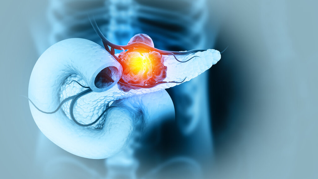 Natural tooth count associated with long-term survival after pancreatic cancer surgery