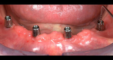 Implant-supported mandibular complete prosthesis with conometric retention after three years