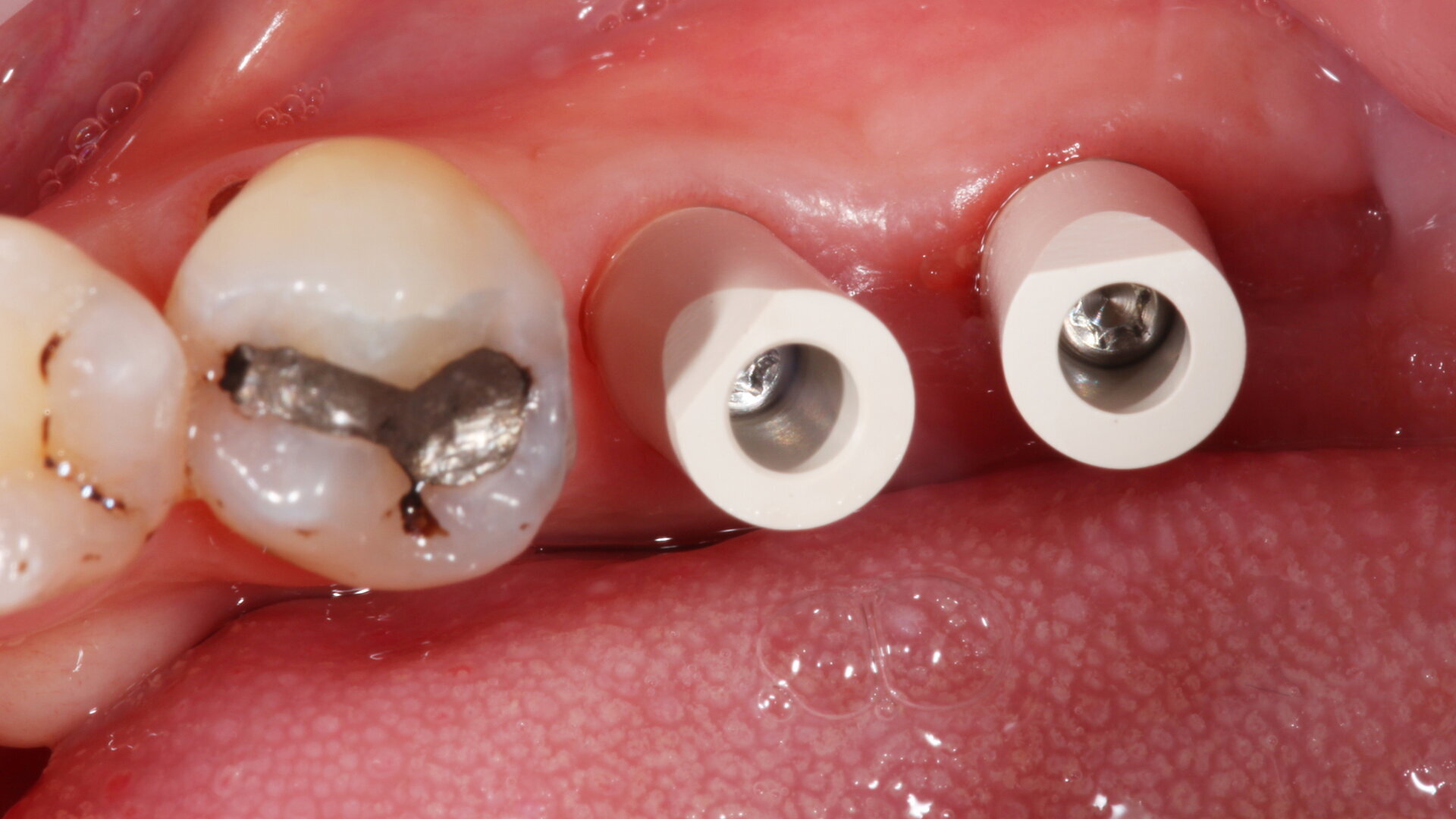 Mastering the implant digital workflow