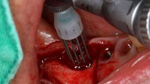 Une nouvelle procédure chirurgicale peut aider à combattre la péri-implantite