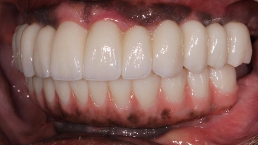Fig. 32: Left lateral view of the teeth in maximum intercuspation.