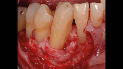 L’azione del gel di xantano e clorexidina come complemento ai trattamenti chirurgici parodontali