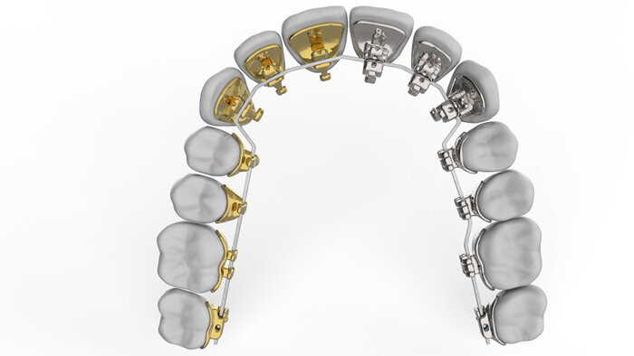 O lingvální ortodoncii