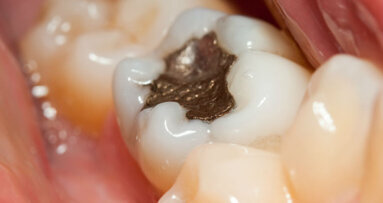 Sul tema “amalgama” aggiornamenti, prospettive ed implicazioni legali