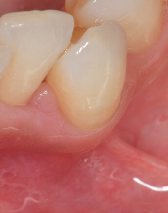 Fig. 6 - Visione occlusale del difetto trattato a 7 giorni di follow-up. Notare l’assenza di infiammazione e il tessuto guarito.