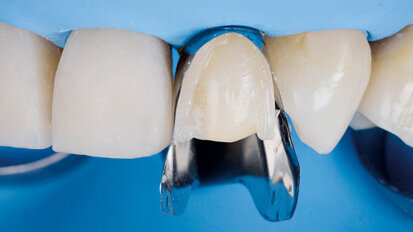 Přímé vrstvení kompozitních fazet