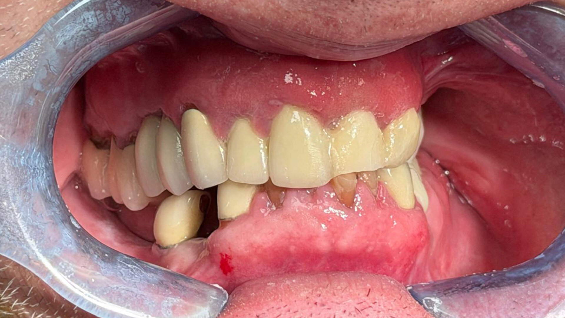 Slide-and-tilt stackable surgical guides for full‑arch implant reconstruction—Part 1: Maxillary arch