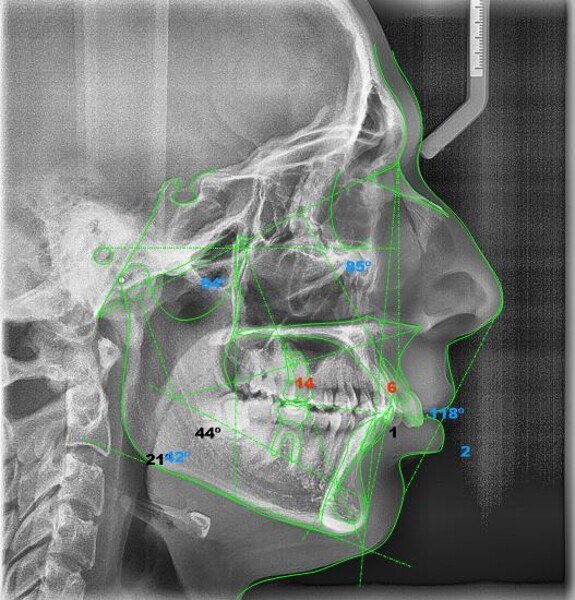 Fig. 6: Ricketts cephalometric analysis (image generated using NemoCeph Studio).