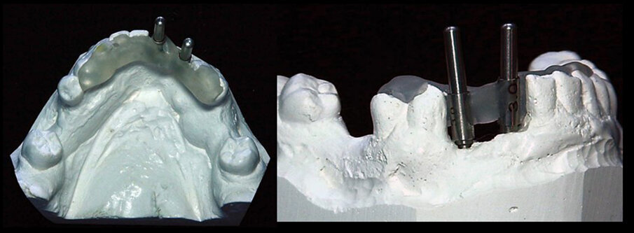 Figs. 4a & b: Triad gel was added to create a diagnostic stent that used the adjacent teeth for stability and locked to the guide sleeves’ cleats.