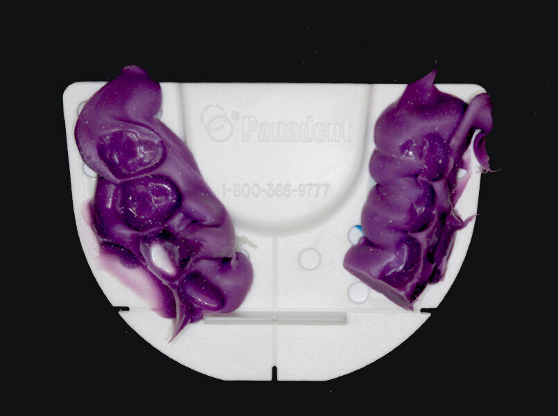Fig. 3: Index tray with bite registration material.