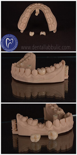 Slika 6: izgled definitivnog protetskog rada, od litijum disilikatne keramike; Model isprintan na DWS XFAB 3D printeru. Ordinacija Veljkov, dr Dejan Veljkov