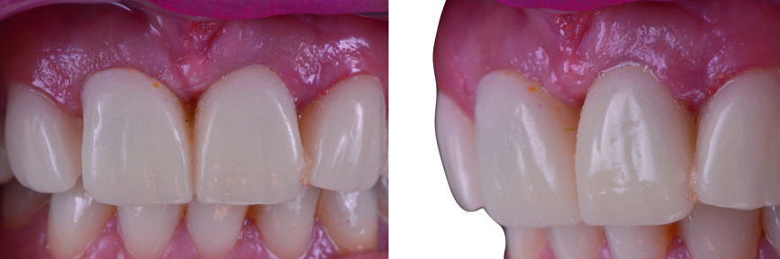 Figs. 21–23 : Restaurations provisoires vissées sur les implants. 