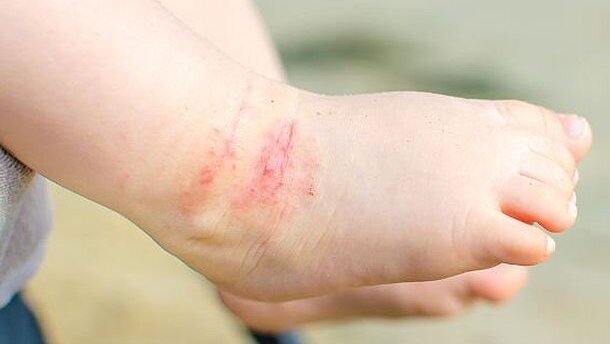 Kinderen met eczeem hebben meer kans op cariës