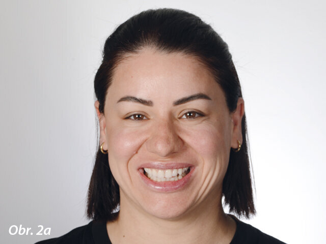 Cílem tohoto estetického ošetření bylo vylepšit úsměv pacientky. Při úpravě nebo korekci smile designu je však vedle všech základních estetických parametrů rovněž důležité zohlednit analýzu obličeje a osobnost pacientky, a to proto, aby bylo možno při současné minimální invazivitě vytvořit co nejpřirozenější personalizovaný smile design.