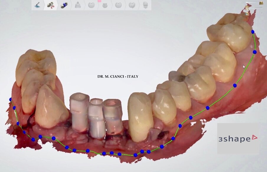 Fig. 9 - Fase CAD 3Shape Dental Designer (scan body).