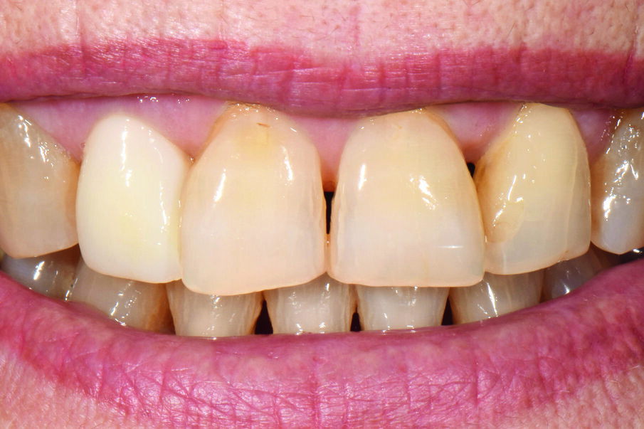 Fig. 1: Initial Situation: Condition of tooth 12 after full crown preparation, intraoral scan and provisional restoration.
