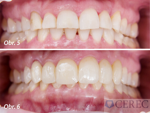 Výsledek po 9 měsících ortodontické léčby a po fixaci fazet v horní čelisti