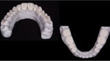 Fig. 12. Carillas y coronas finales preparadas digitalmente con el software de diseño Ceramill Mind y producidas en una fresadora (Ceramill Motion 2) a partir de bloques de cerámica de disilicato de litio mecanizables (VITABLOCS TriLuxe forte).