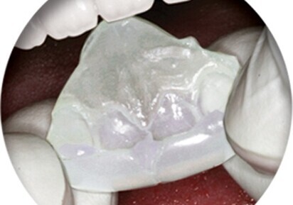 NiteBite helps bruxing patients