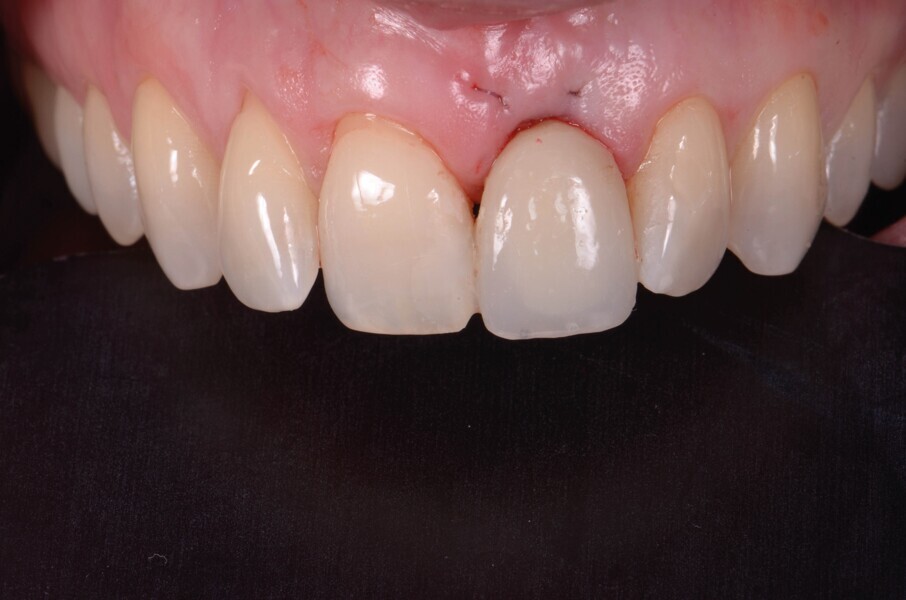 Fig. 13a : Immédiatement après la pose de l’implant. 