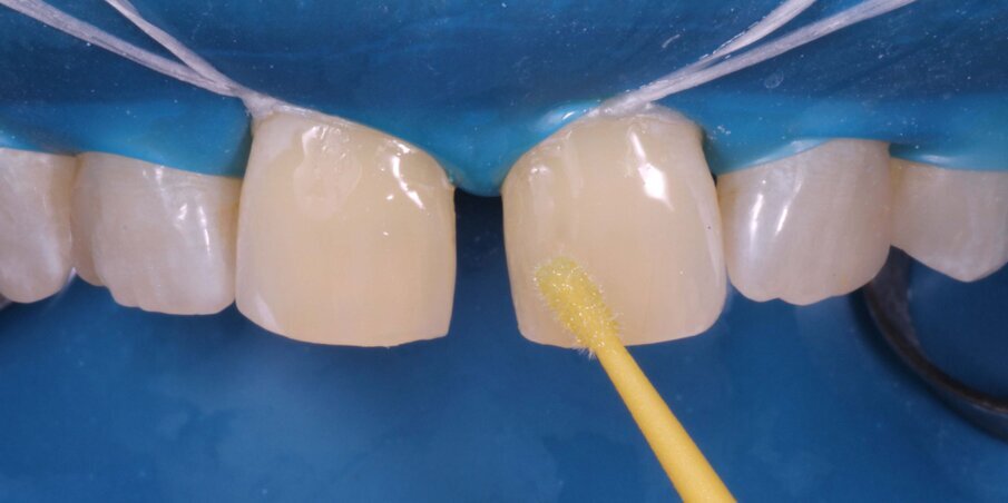 Fig 4. Application of bonding agent