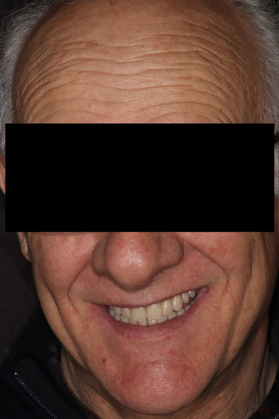 Figg. 10a, 10b_Il sorriso del paziente prima e dopo la fine della terapia.