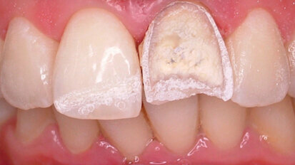 Laser Er:YAG et élimination des résines composites