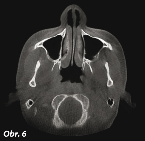 Transverzální rovina