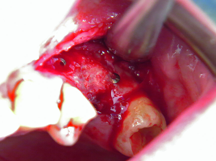 Fig. 17: Use of membrane. Pins visible.