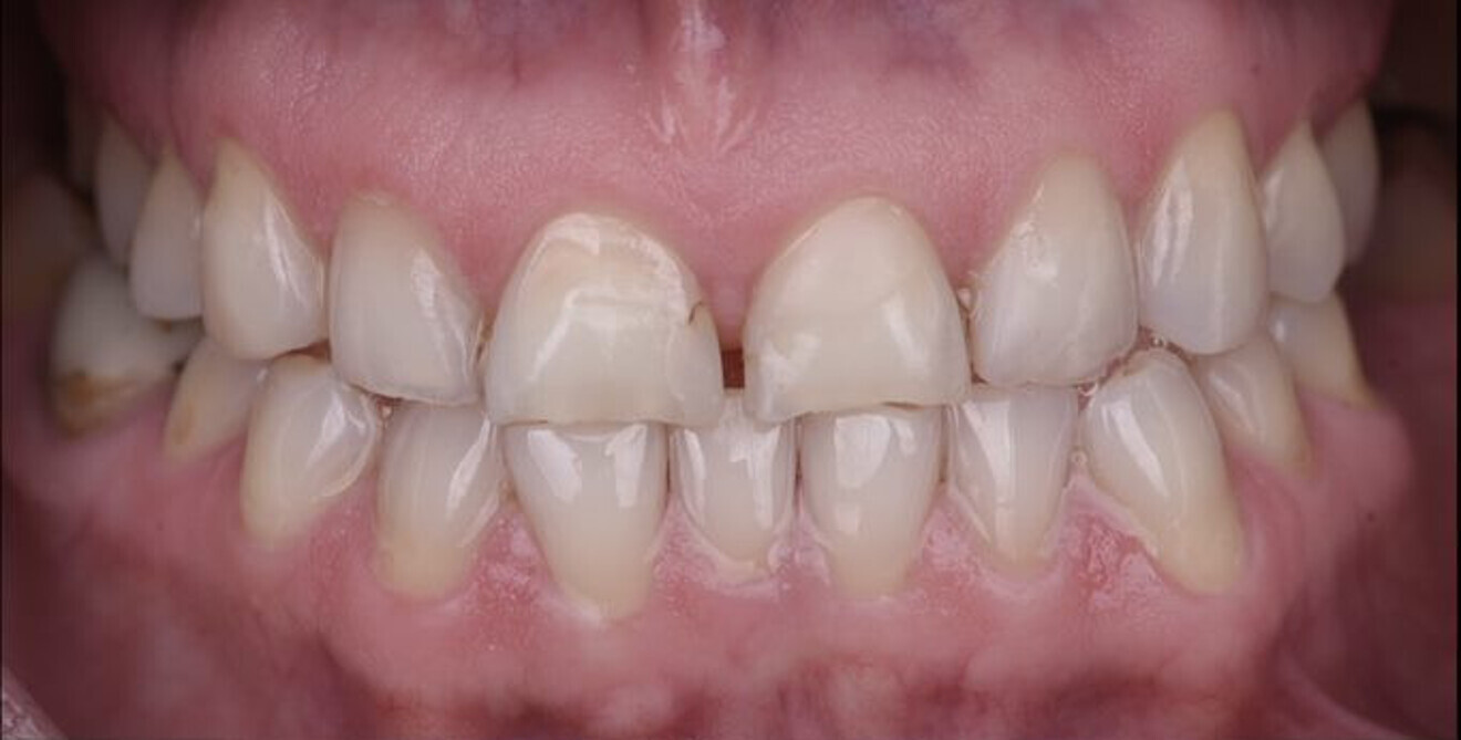 Fig. 1a: Intra-oral view with the teeth in maximum intercuspation.