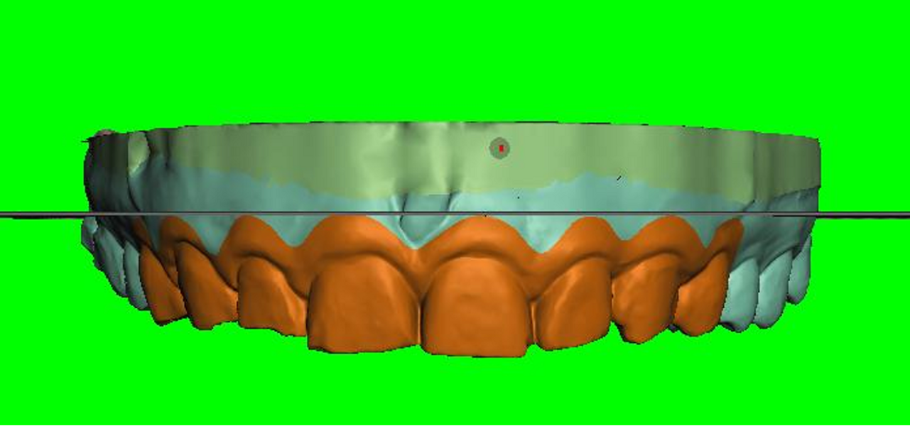 Fig. 7: Digital planning of soft-tissue recontouring done in-house at the AORTA dental laboratory.