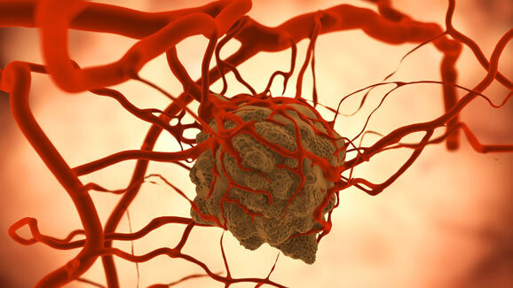 Kampagne der EHNS gegen Kopf-Hals-Krebs