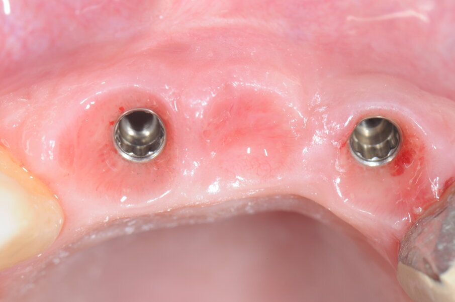 Figg. 25a, 25b - Valutazione dei tessuti molli in visione frontale e occlusale in assenza di protesi definitiva.