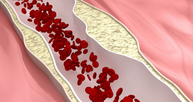 La terapia periodontal mejora el corazón en poblaciones de alto riesgo