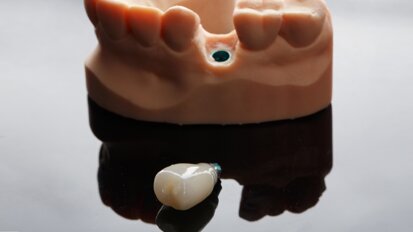 3D-printed hybrid composite restoration in a fully digital workflow