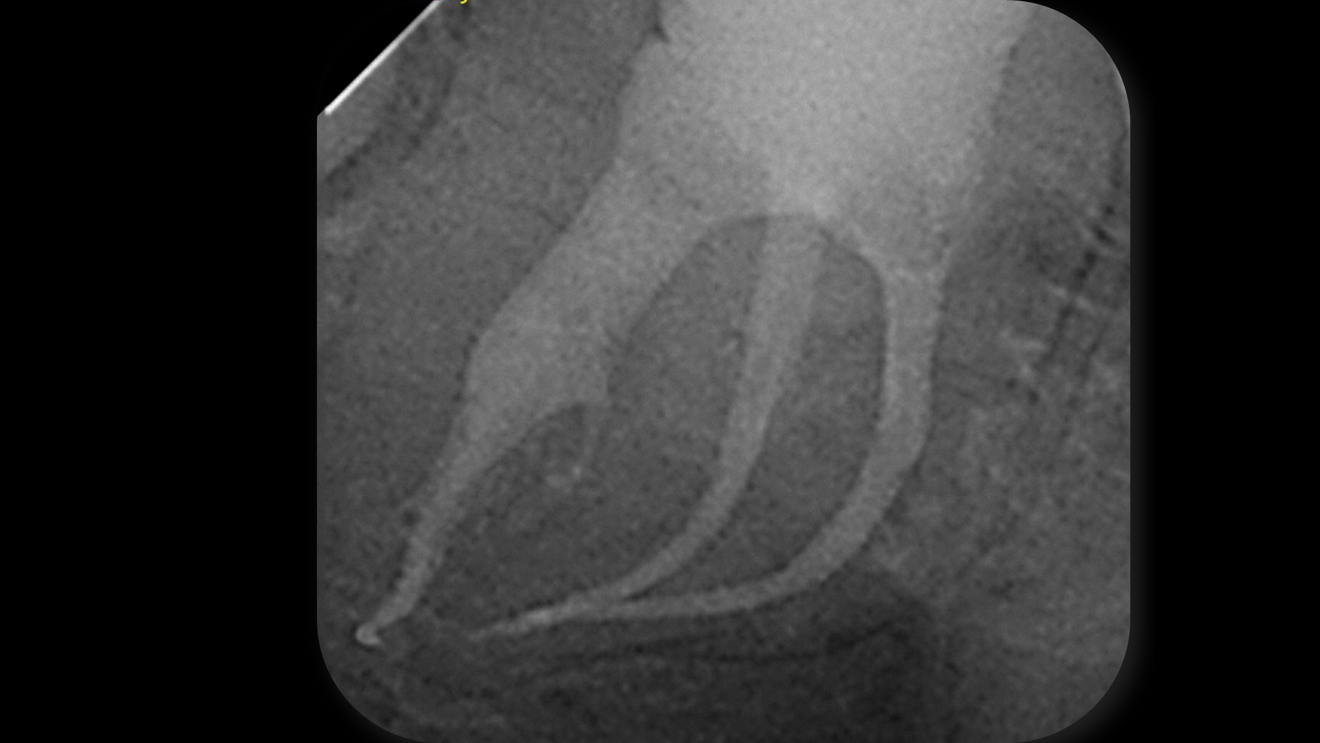 Fig. 5: Angulated post-op radiograph of the mandibular right second molar demonstrating the curvature of the mesial canals and the dense 3D obturation achieved up to working length.