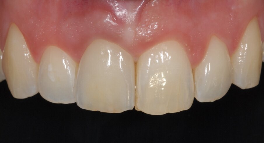 Fig. 6 - Corona defi nitiva in zirconia ceramica avvitata sull’impianto. Il profi lo d’emergenza è assolutamente simile a quello dell’elemento adiacente.
