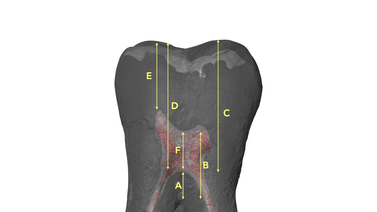 Fig. 13: Locations of the measurements performed by Deutsch et al. on a micro-CT scan of a mandibular molar.8, 9 A = pulp chamber floor to furcation; B = pulp chamber roof to furcation; C = buccal cusp to furcation; D = buccal cusp to pulp chamber floor; E = buccal cusp to pulp chamber roof; F = pulp chamber height.8, 9 (Image: Elio Berutti) 