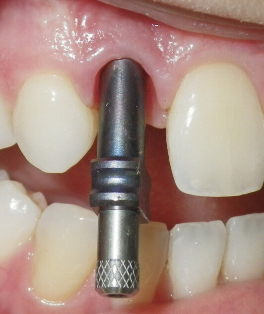 Fig. 2. A pickup impression coping has been secured to the implant. Note the central screw which extends out of the implant impression sleeve.