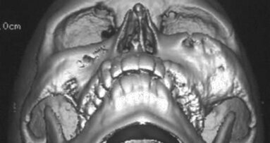 Interview: Diagnosing fibro-osseous lesions