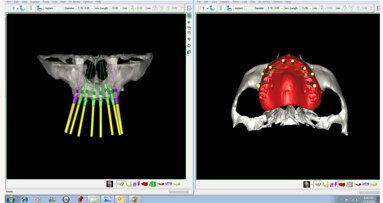 Immediate restoration in the fully edentulous maxilla region
