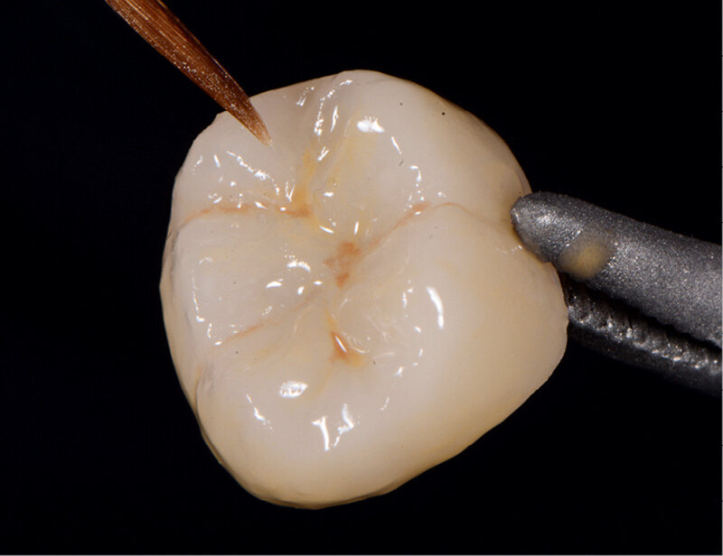 Fig. 4: Characterised and glazed crown. 