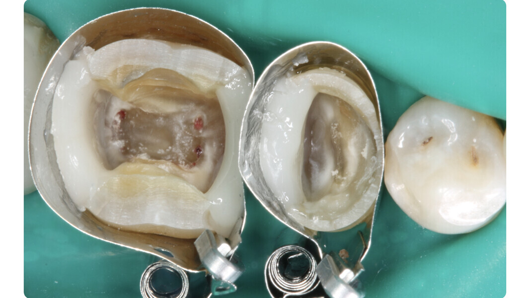 Fig. 10: Completion of the reconstructions of the missing walls.