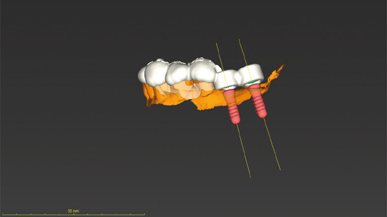 Digitalizace vaší implantologické praxe
