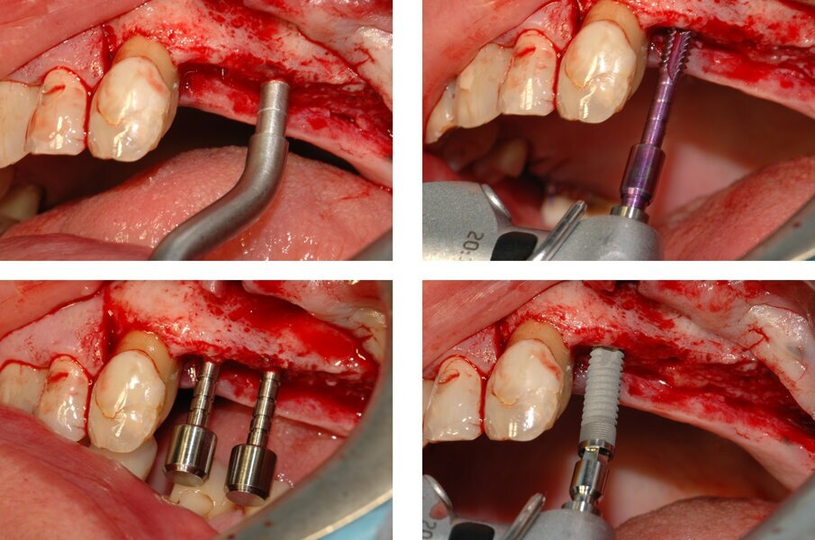 Fig. 3_La preparazione dei siti implantari in posizione 2.5 e 2.6 ed il posizionamento del primo impianto in posizione 2.5. Prima dell’allargamento del sito implantare utilizzando l’ultima fresa, la densità ossea viene letta attraverso una sonda collegata al manipolo di un apposito micromotore (seconda immagine in alto); l’informazione è utilizzata per decidere razionalmente un opportuno protocollo di sottopreparazione. 
