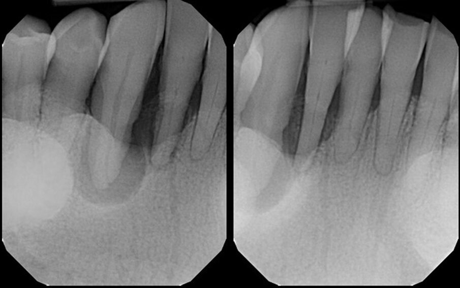 Figs. 1a & b: Pretreatment radiograph demonstrating signicant bone loss associated with the mandibular right central incisor, lateral incisor and canine.